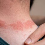 Betametacron: How It Works on Skin Conditions