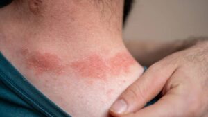 Betametacron: How It Works on Skin Conditions