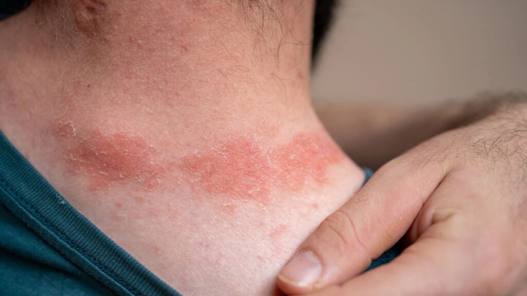 Betametacron: How It Works on Skin Conditions